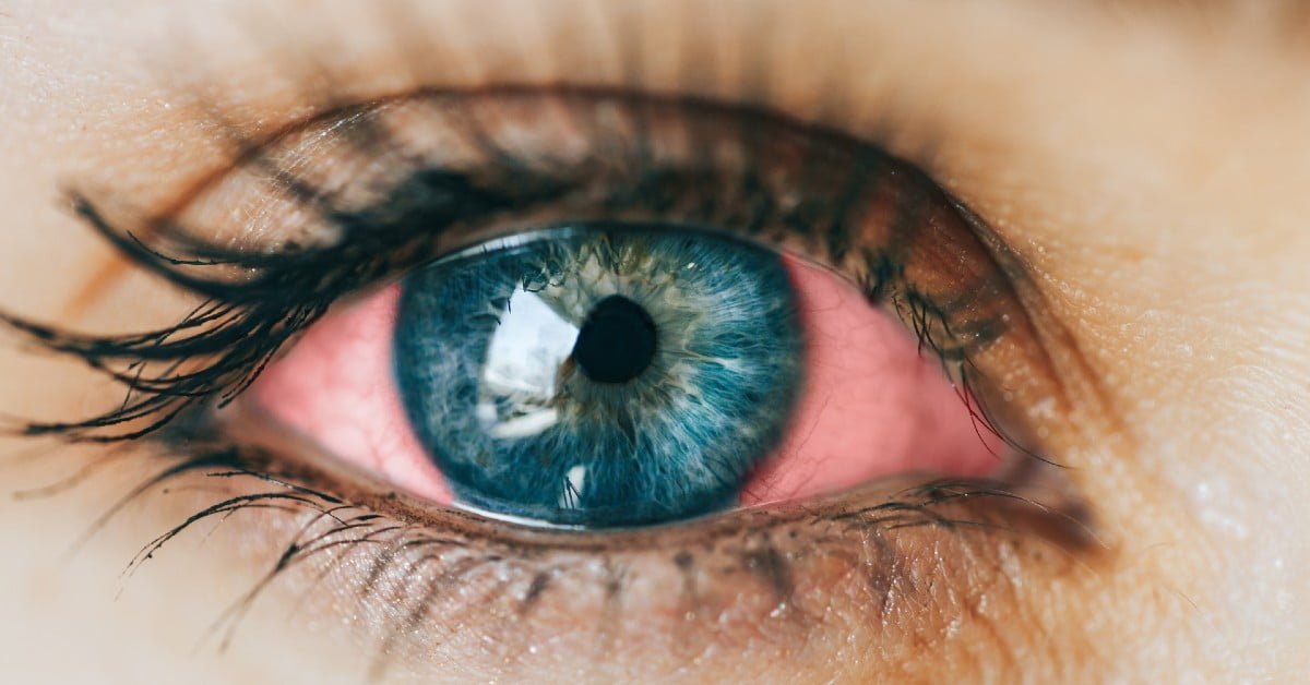 What Is Commonly Misdiagnosed as Pink Eye