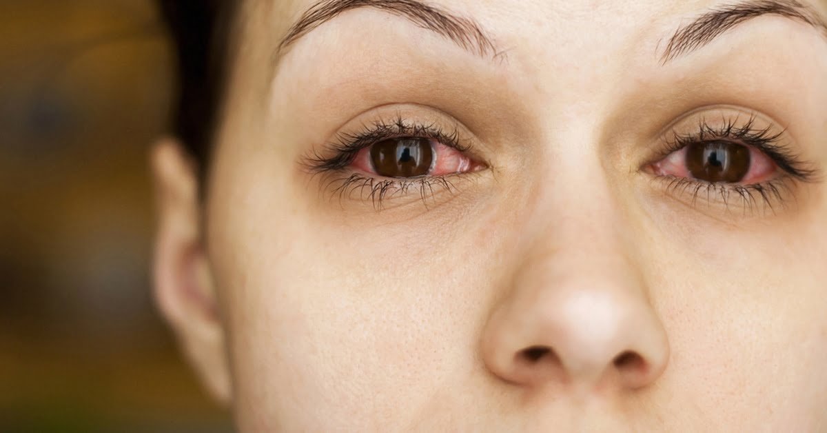 What Is Commonly Misdiagnosed as Pink Eye