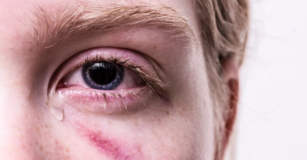 What Is Commonly Misdiagnosed as Pink Eye