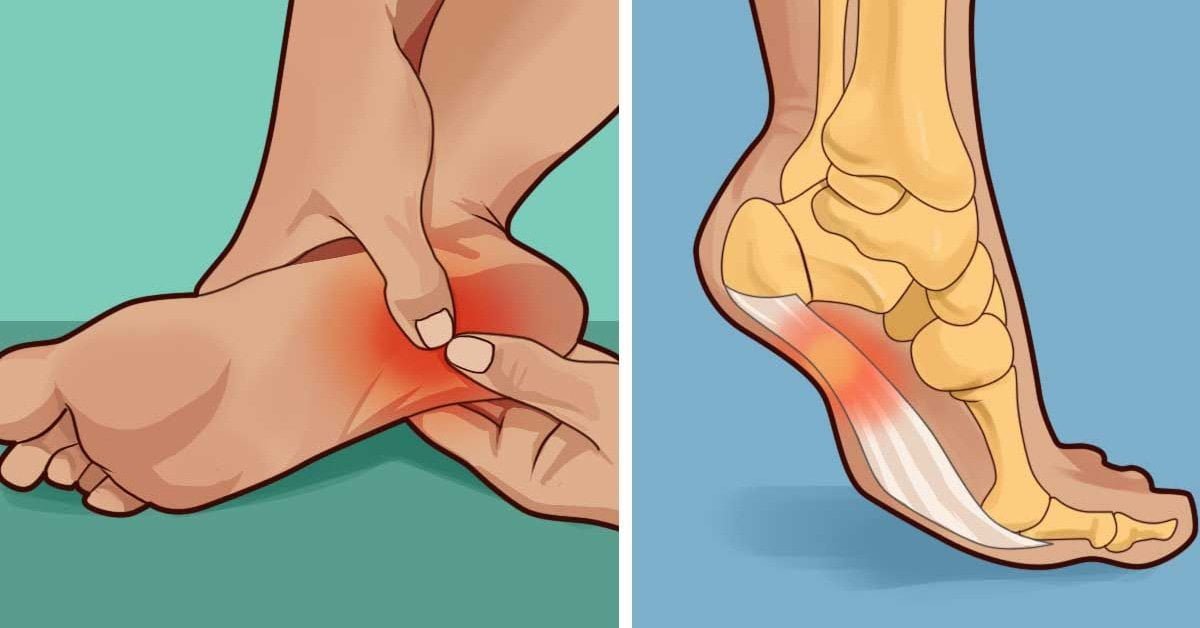 How to Cure Plantar Fasciitis in One Week