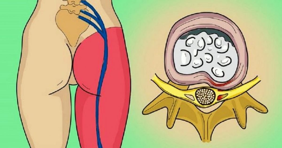 Last Stages of Sciatica