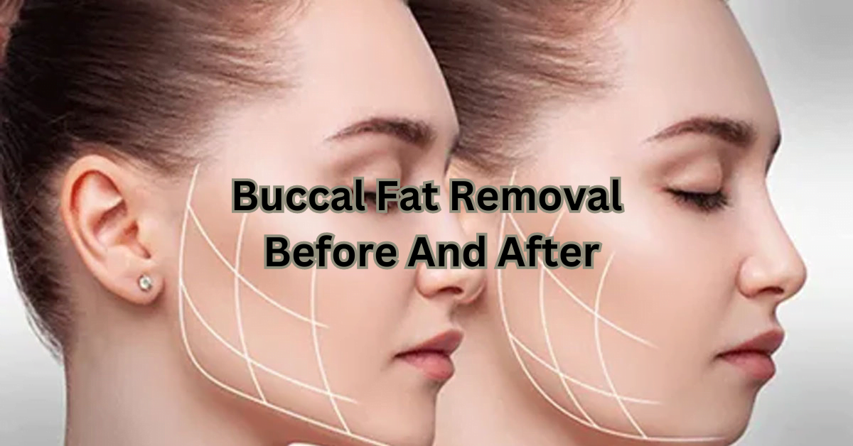 Buccal Fat Removal Before And After