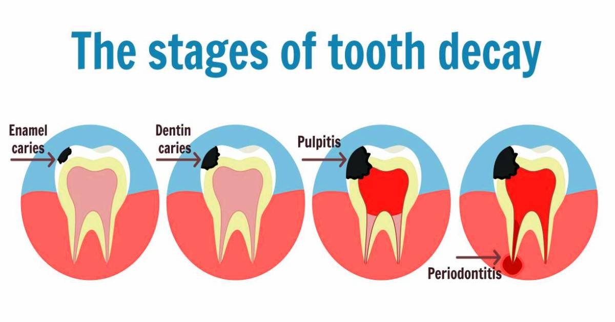 How Long Until a Tooth Infection Kills You