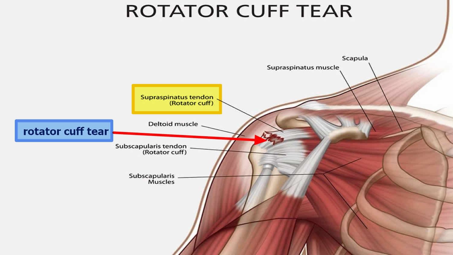 Shoulder Pain Diagnosis Chart